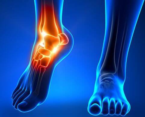 Total Ankle Replacement: An Option for Arthritis and Chronic Pain