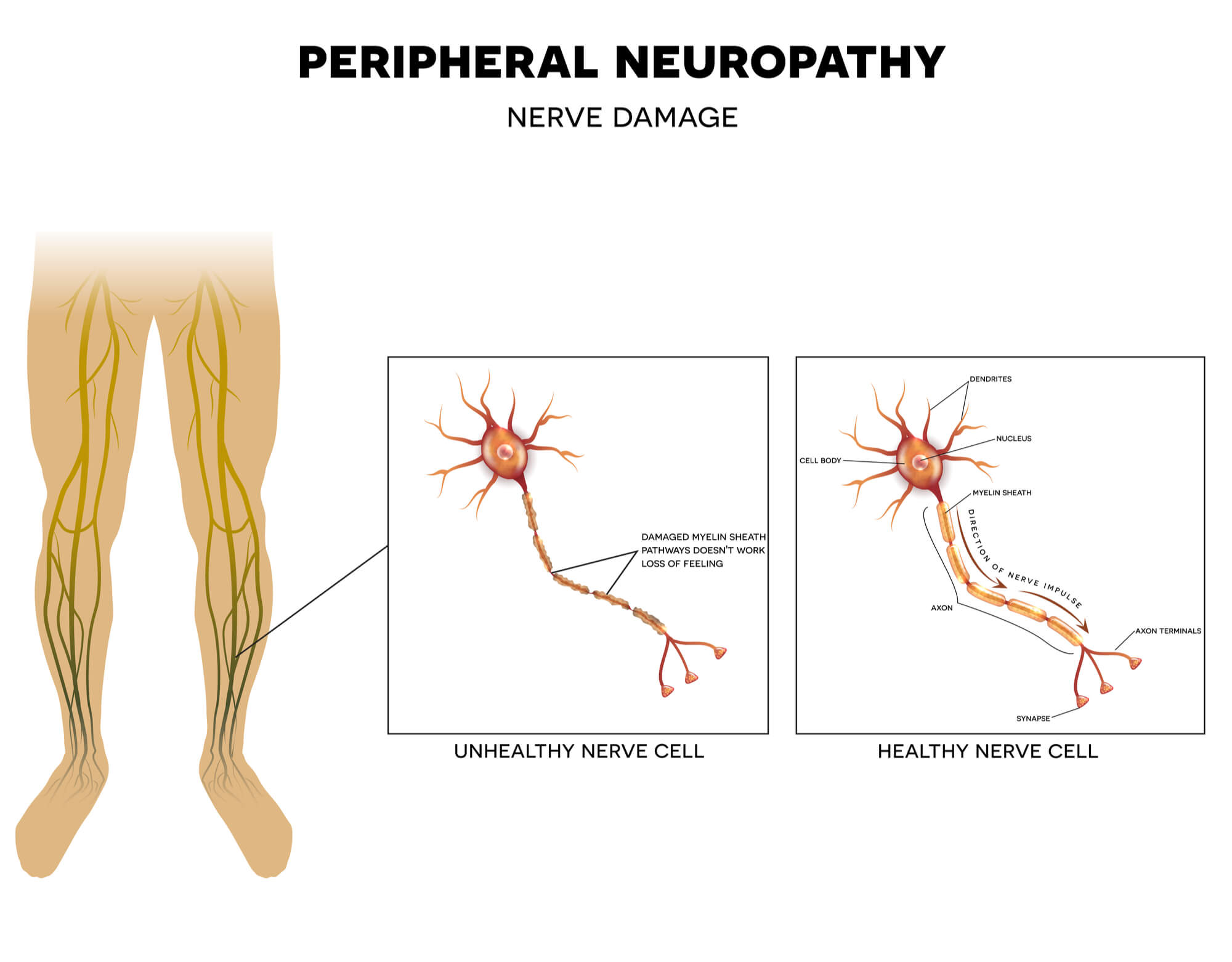 Peripheral Neuropathy is Life Threating