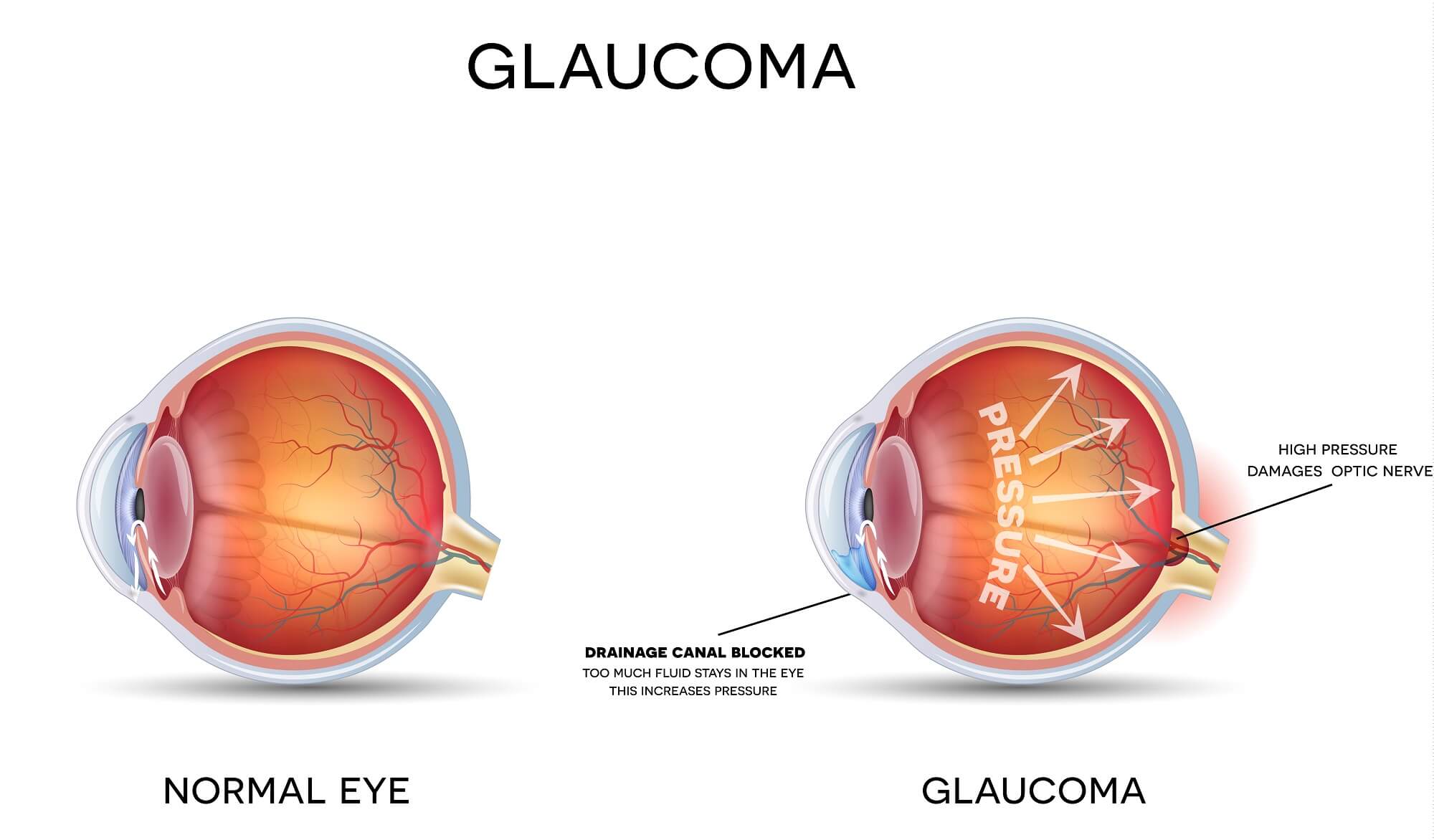 6 Ways to Prevent Glaucoma